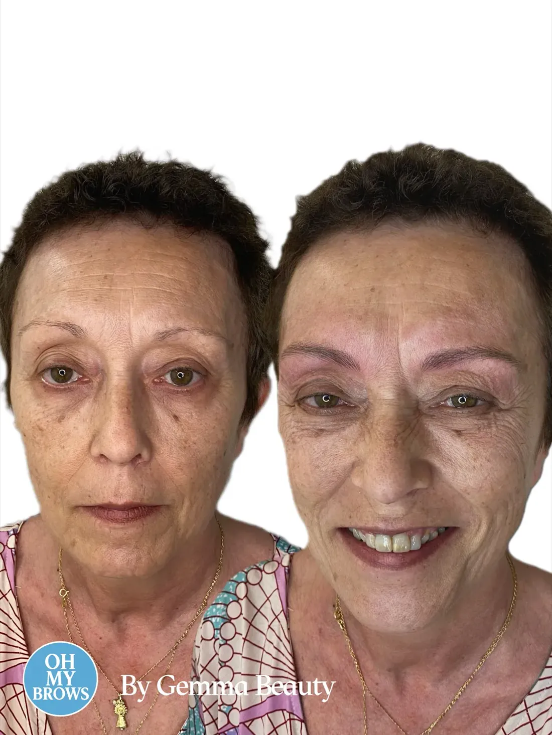 Resultado hiperrealista de cejas Hairstroke en un caso de alopecia